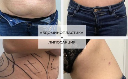 Операция абдоминопластика живота, фото до и после