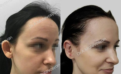 Фото до и после операции на уши