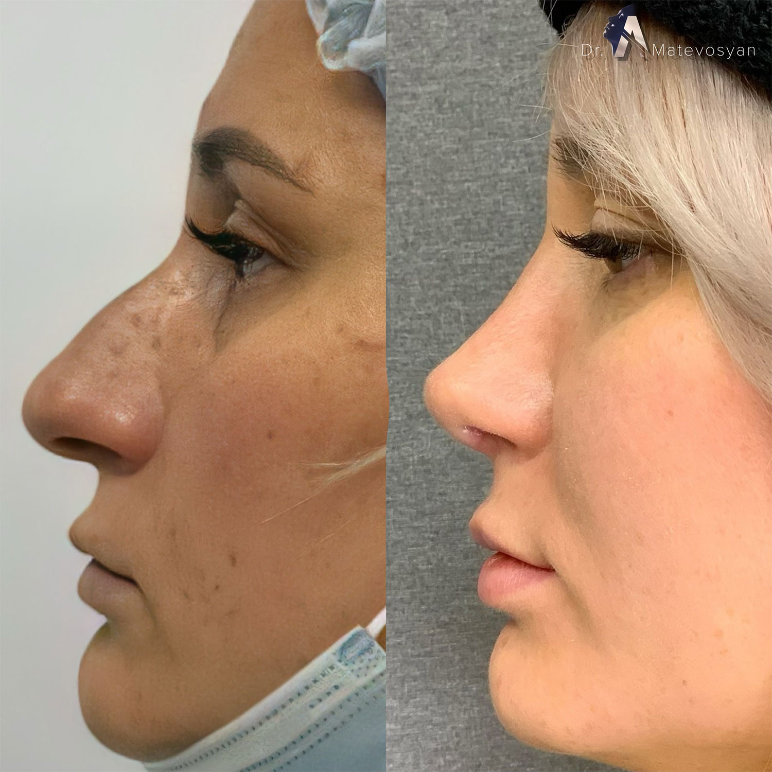 фото ринопластики до и после нос